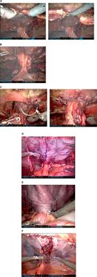 Robotic Retromuscular (Recurrent) Parastomal Hernia Repair (r-Pauli-Repair) With Synthetically Reinforced Biological Mesh; Technique, Early Experience, and Short-Term Follow-Up